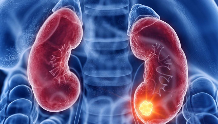 Protein in Urine Should You Worry